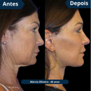 Máscara de Colágeno Verisol - Retire Imperfeições Faciais |COMPRE 1 LEVE 3|Frete Grátis